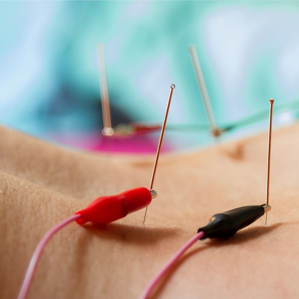 Electro Acupuncture