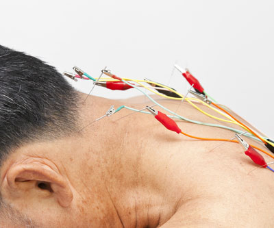 electro-acupuncture Electro Homeopathy